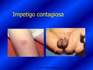 Impetigo contagiosa




        BY DR M OSAMA HUSSEIN MD
 