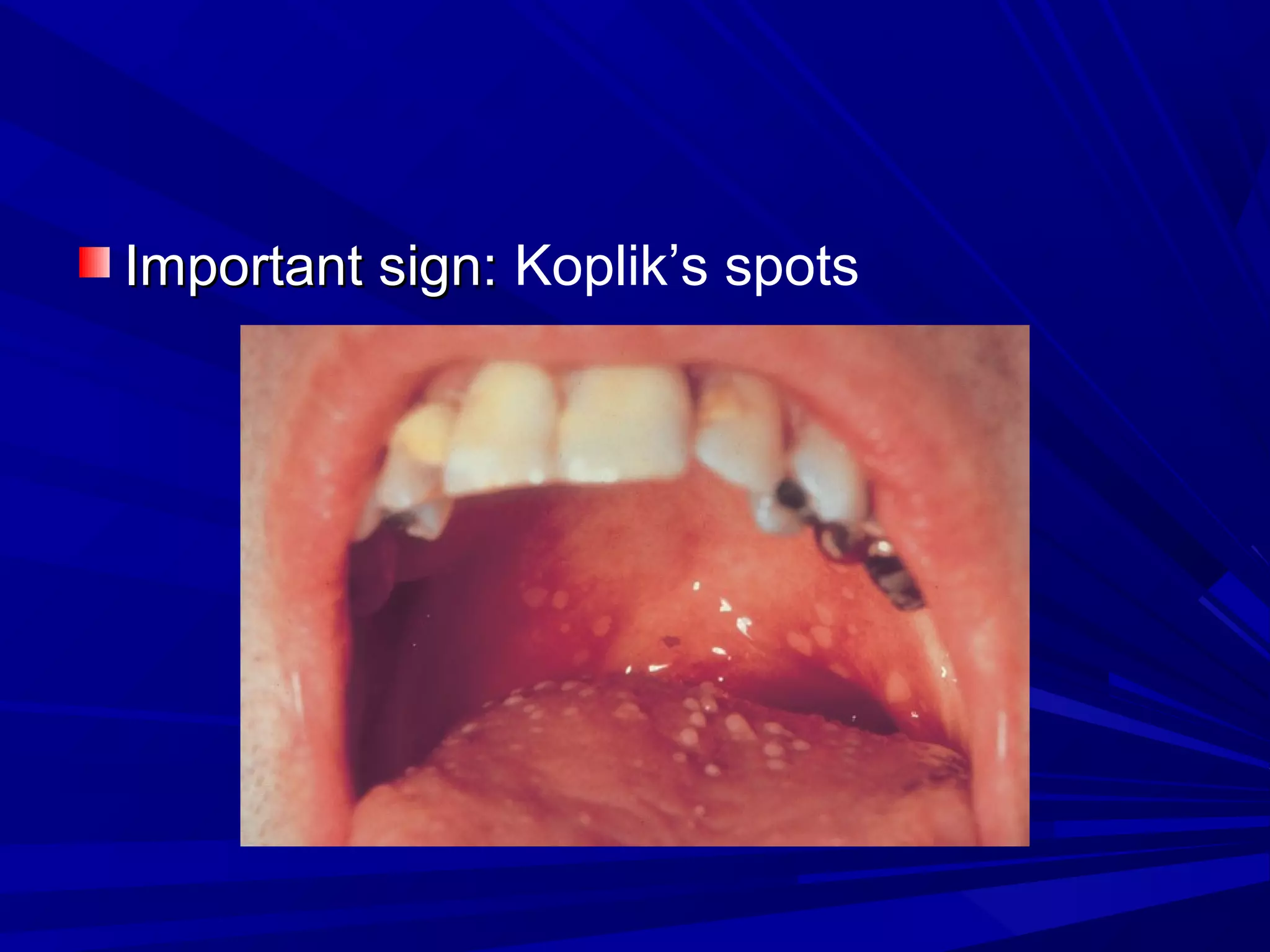 Important sign: Koplik’s spots

 