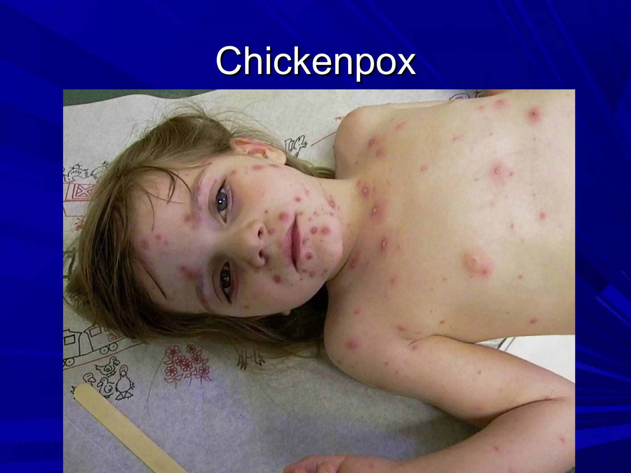 Chickenpox

 