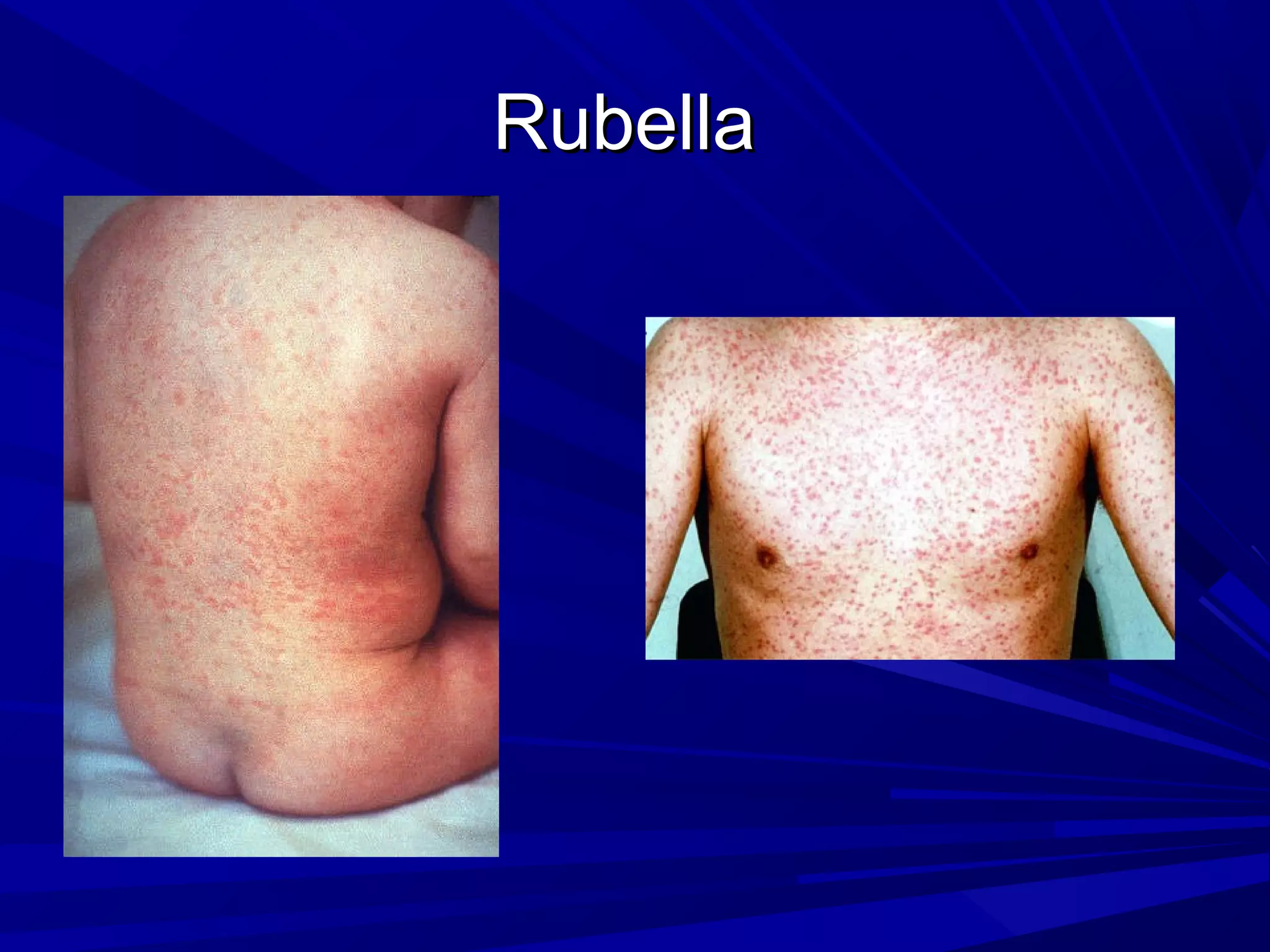Rubella

 