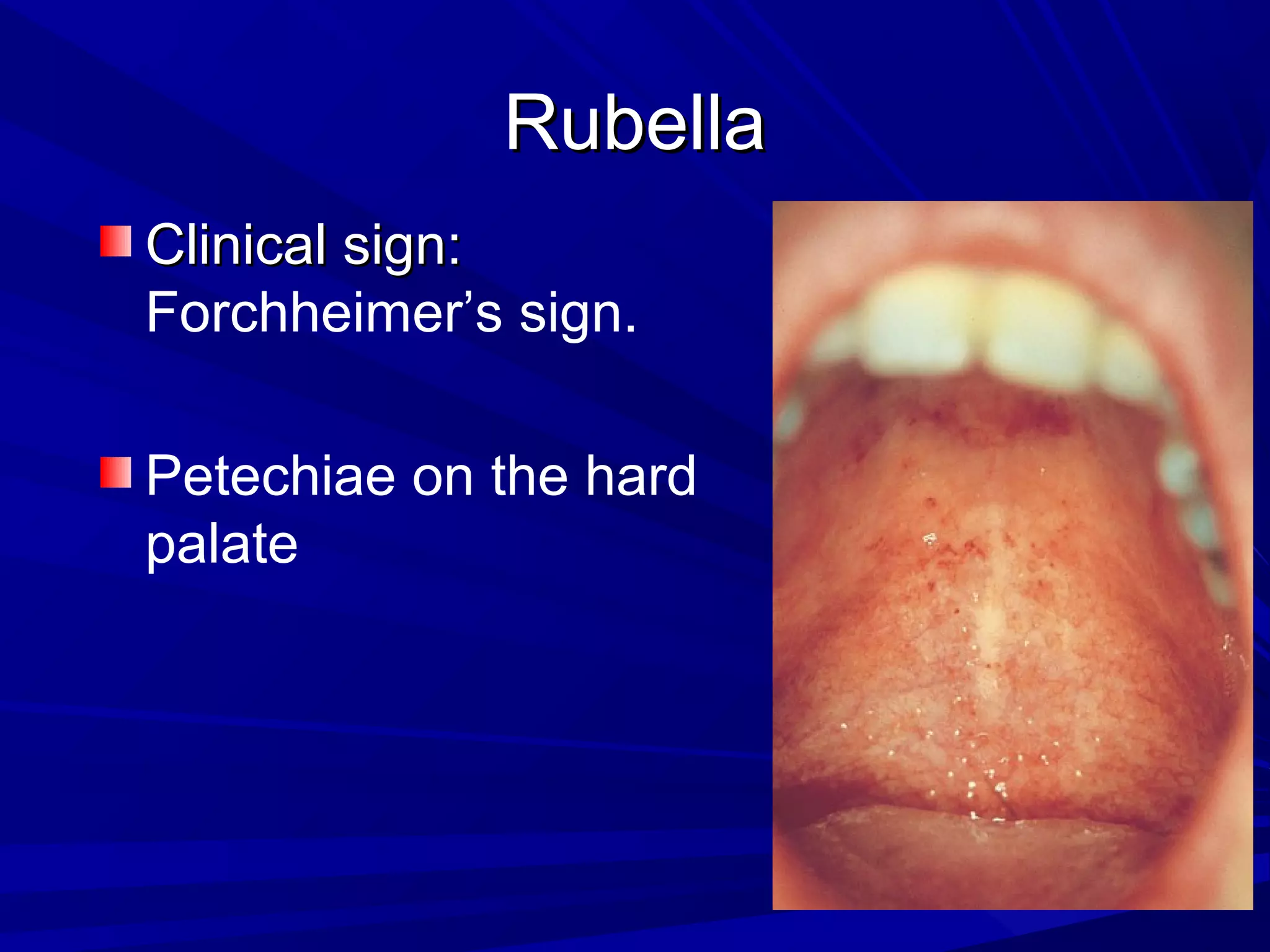 Rubella
Clinical sign:
Forchheimer’s sign.
Petechiae on the hard
palate

 