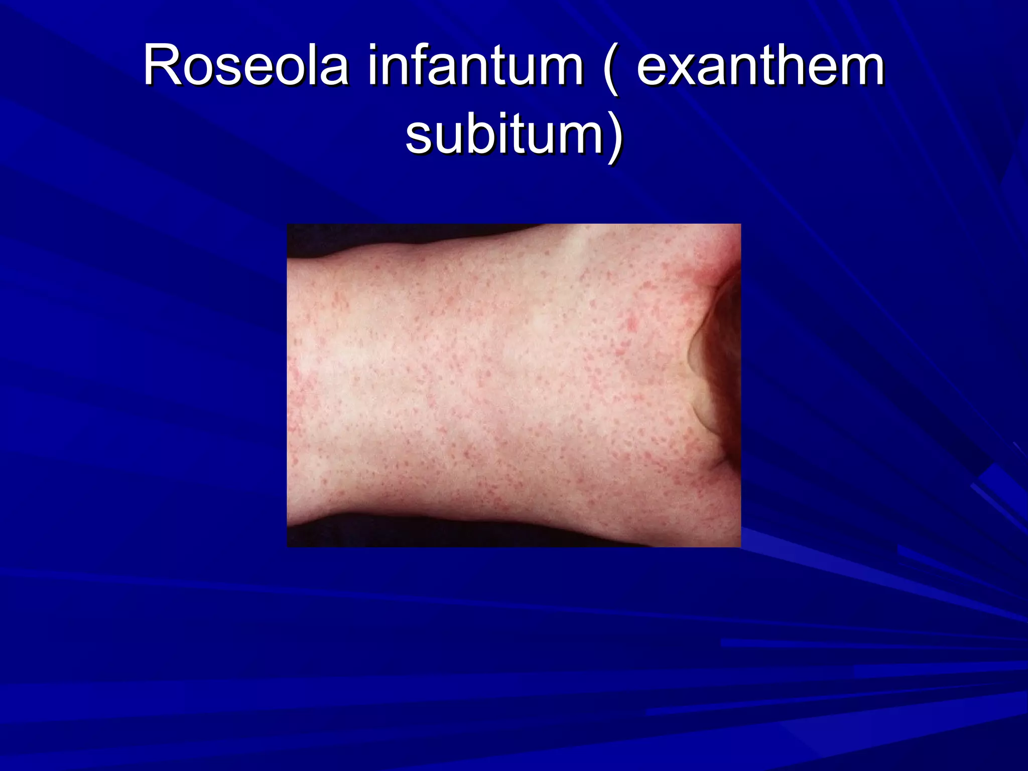 Roseola infantum ( exanthem
subitum)

 