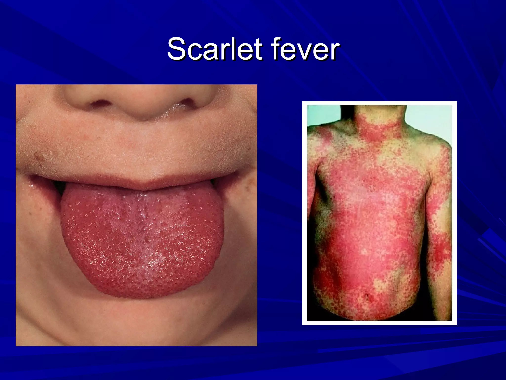 Scarlet fever

 