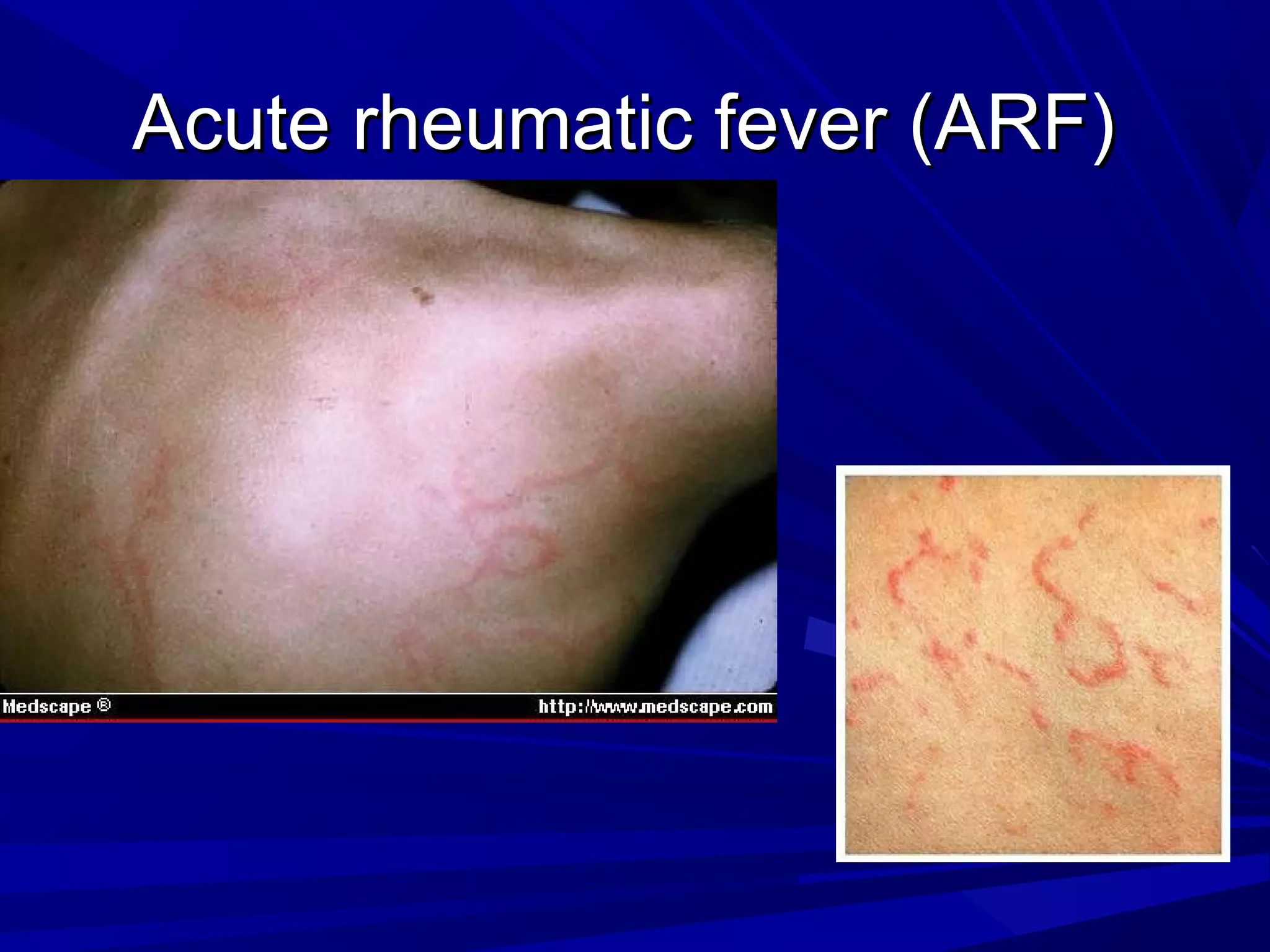 Acute rheumatic fever (ARF)

 