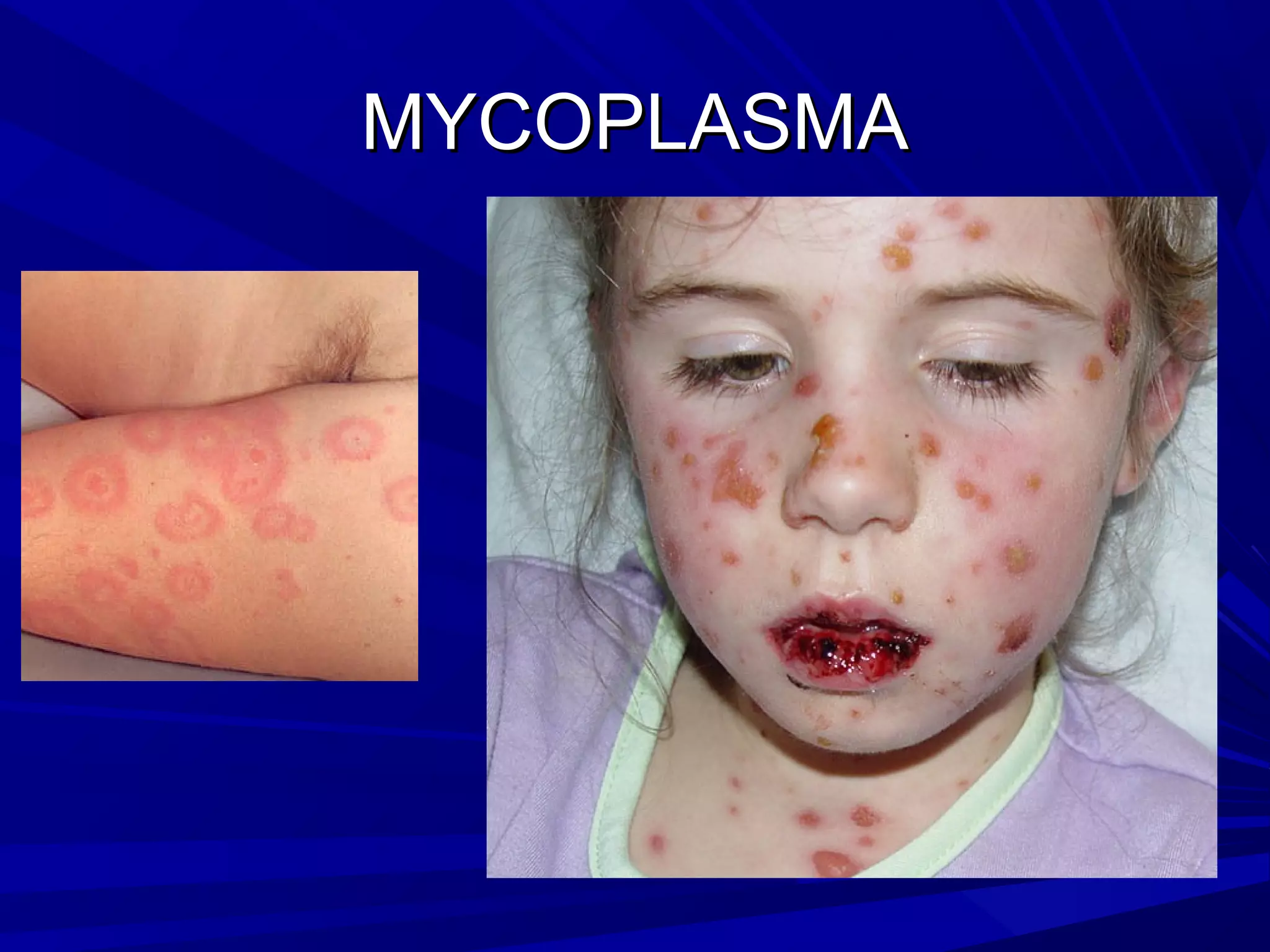 MYCOPLASMA

 