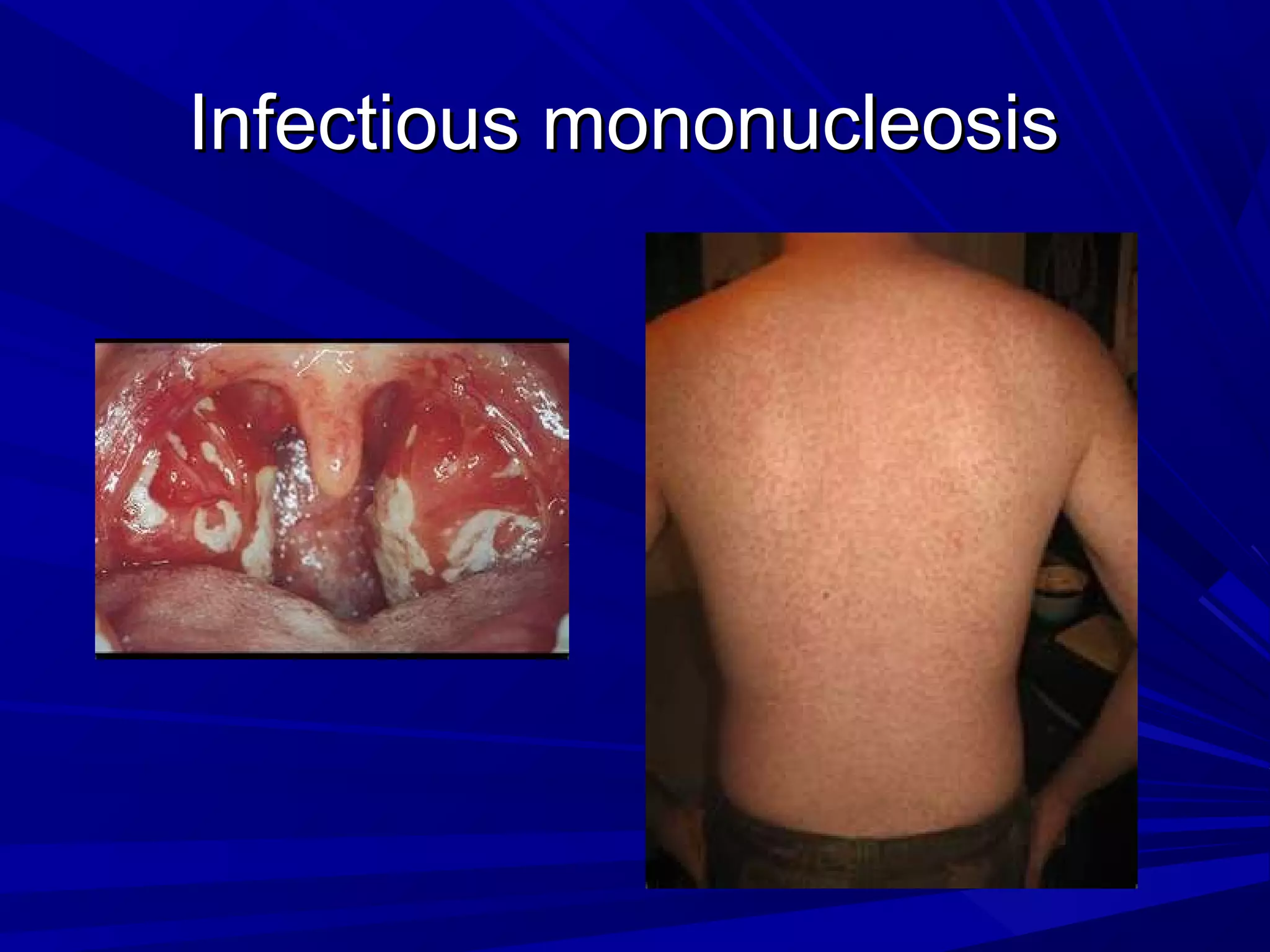 Infectious mononucleosis

 