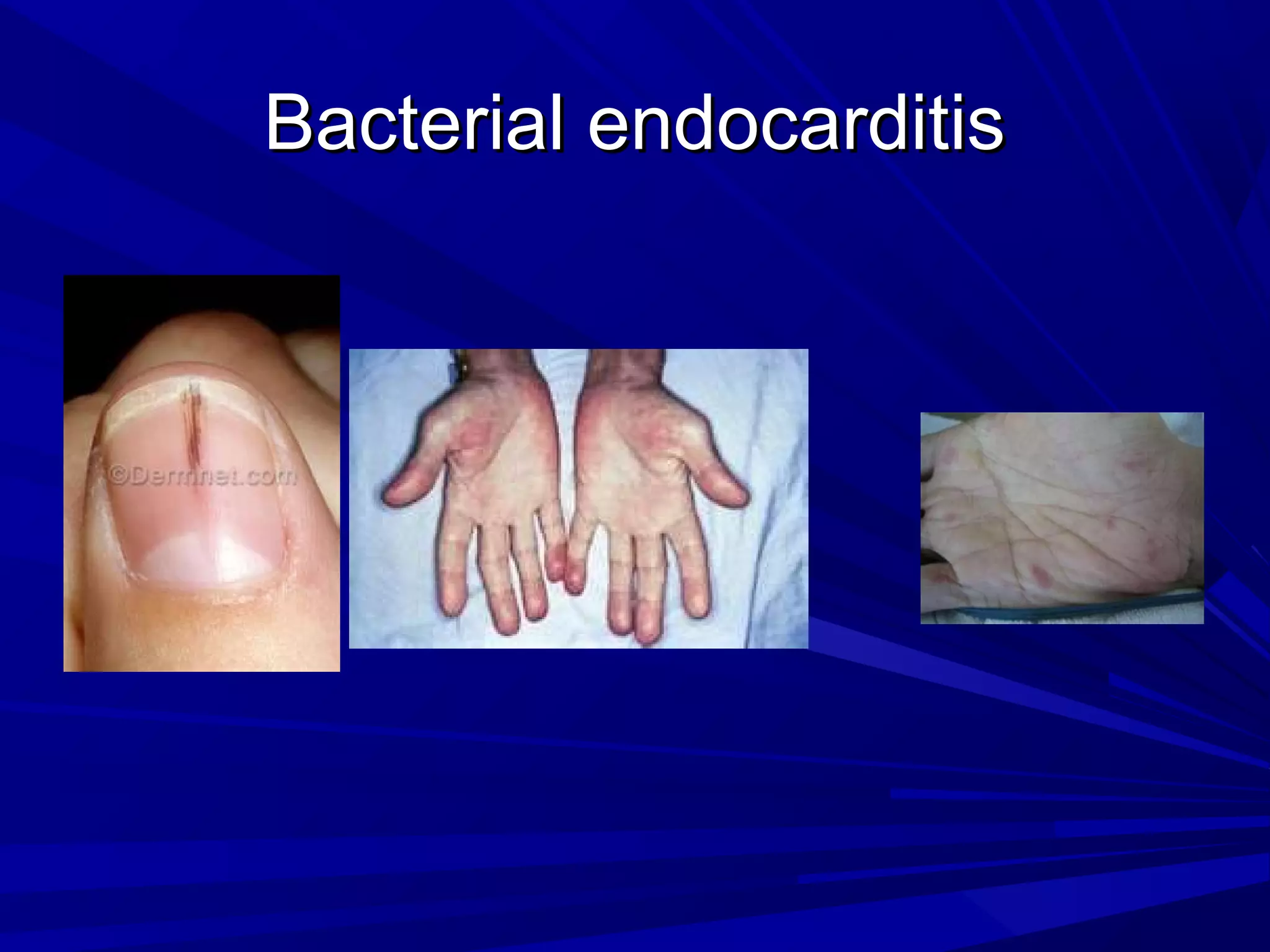 Bacterial endocarditis

 
