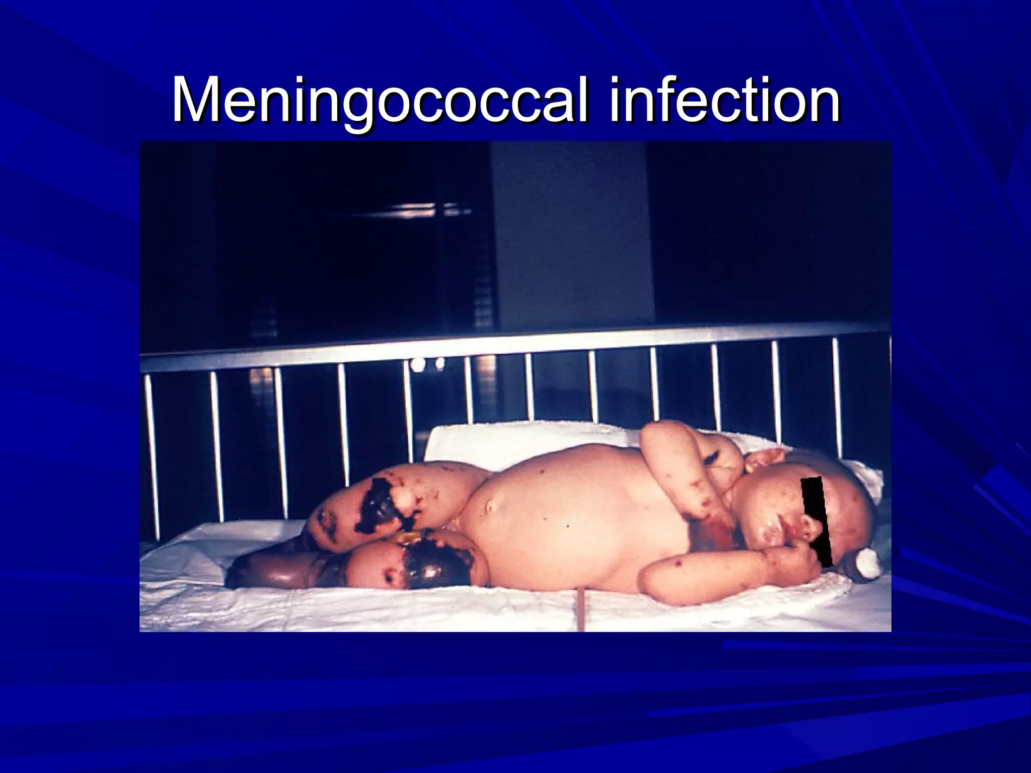 Meningococcal infection

 
