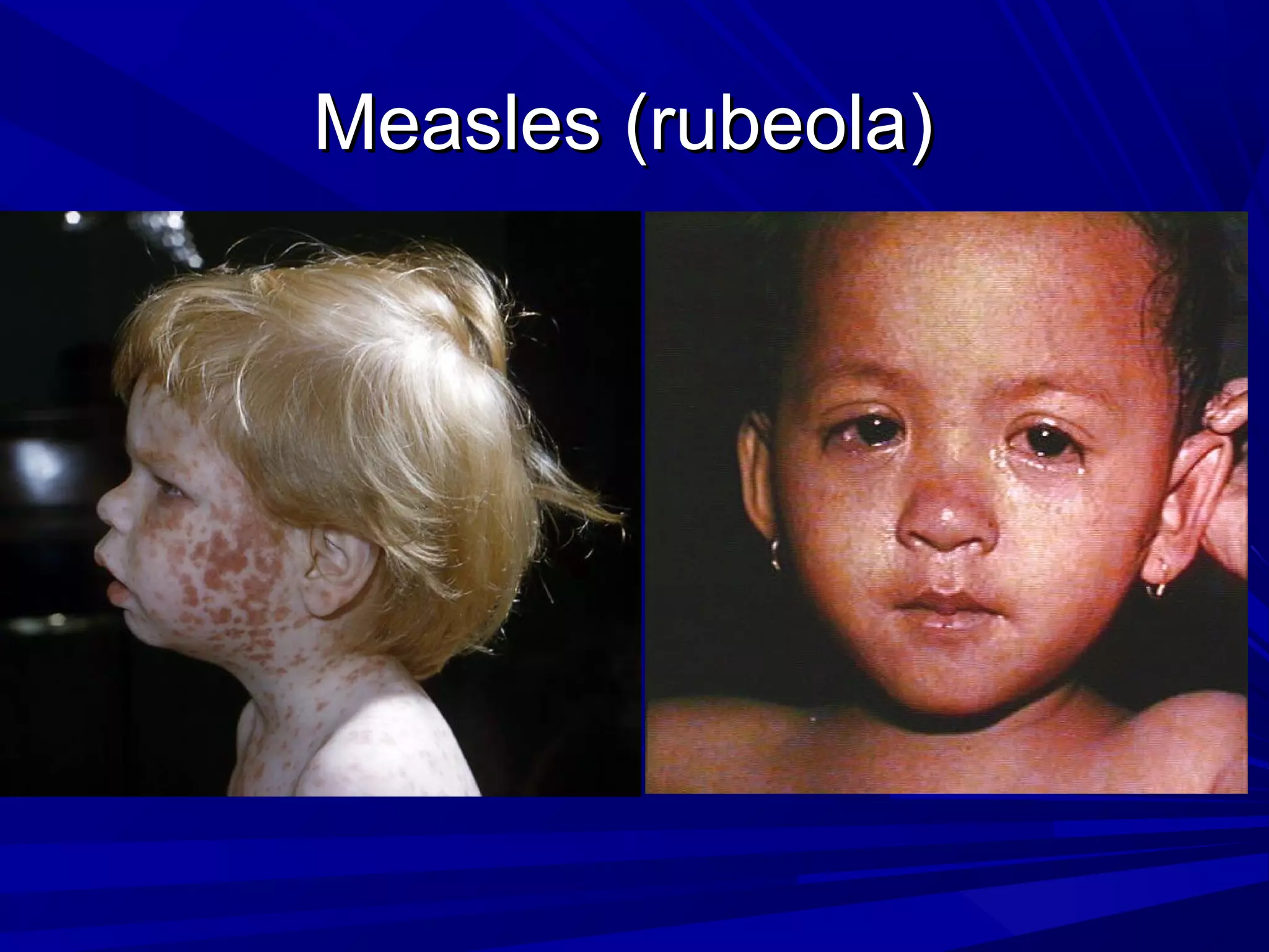 Measles (rubeola)

 