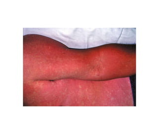 Fever and rash | PPTX