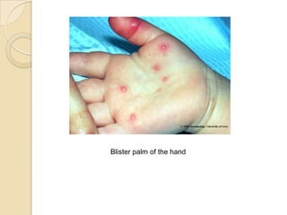Blister palm of the hand
 