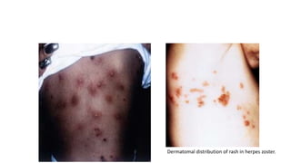 Scarf Distribution Rash fever and rashes.pptx