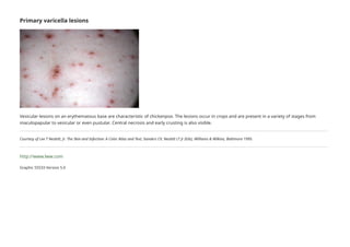 Fever and rash in the immunocompetent patient - UpToDate.pdf
