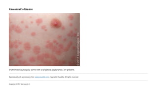 Targetoid Rash Ddx Fever and rash in the immunocompetent patient - UpToDate.pdf