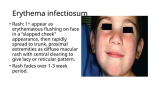 Diffuse Pattern Rash Fever and skin rash - Approach.pptxBy Dr Gururaja R , Paediatrician. An ...