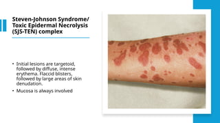 Acetaminophen Skin Rash Fever and skin rash - Approach.pptxBy Dr Gururaja R , Paediatrician. An ...