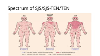 Sjs Target Rash Fever and skin rash - Approach.pptxBy Dr Gururaja R , Paediatrician. An ...