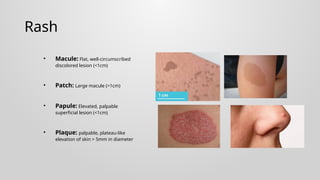 Fever and skin rash - Approach.pptxBy Dr Gururaja R , Paediatrician. An ...