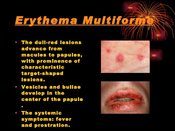 F E V E R A N D S K I N R A S H Final