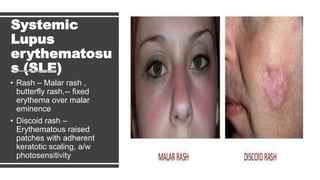 Lupus Rash Distribution Fever | PPTX