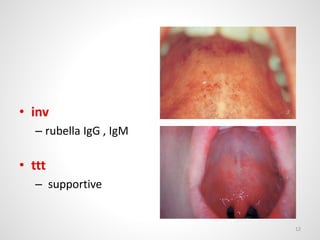 • inv
– rubella IgG , IgM
• ttt
– supportive
12
 
