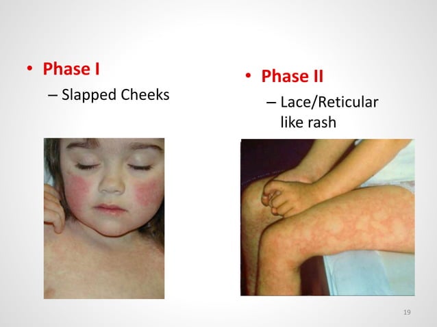Fever and Rash | PPTX