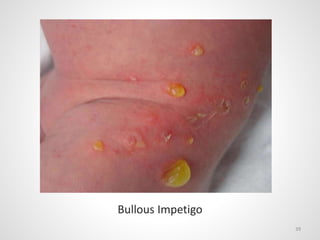 39
Bullous Impetigo
 