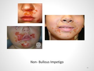 40
Non- Bullous Impetigo
 