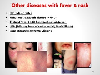 Other diseases with fever & rash
• SLE ( Malar rash )
• Hand, Foot & Mouth disease (HFMD)
• Typhoid Fever ( 30% Rose Spots on abdomen)
• IMN (10% any form of rash – mainly Morbilliform)
• Lyme Disease (Erythema Migrans)
48
 