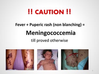 !! CAUTION !!
Fever + Puperic rash (non blanching) =
Meningococcemia
till proved otherwise
5
 