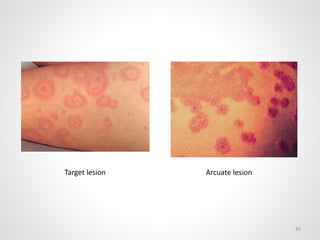Arcuate Rash
