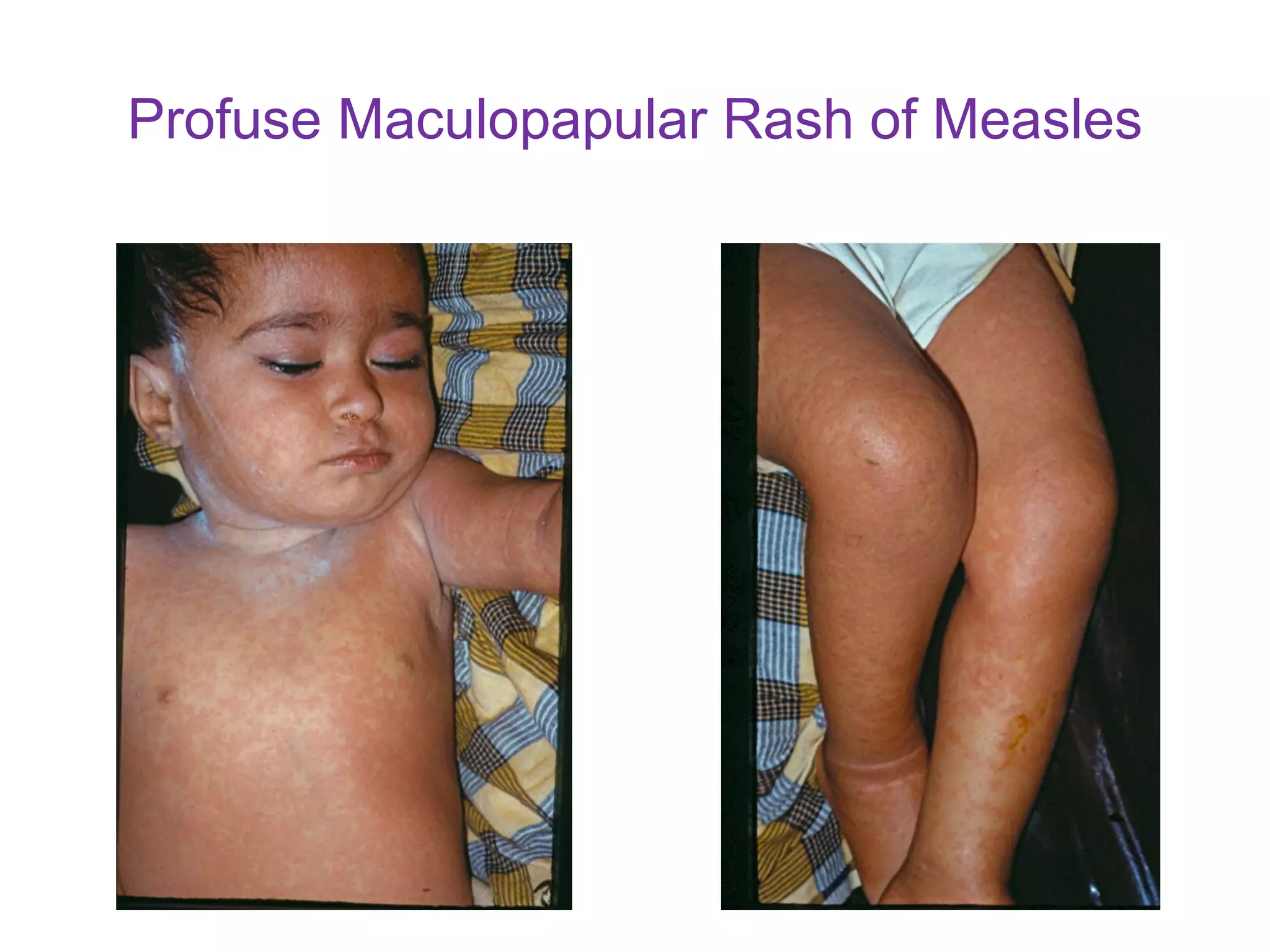 Fever with a maculopapular skin rash in children 2021 | PDF