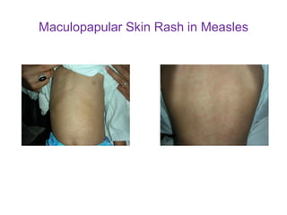 Fever with a maculopapular skin rash in children 2021 | PDF