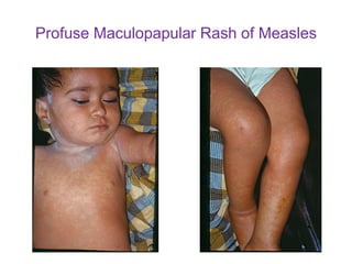Fever with a maculopapular skin rash in children 2021 | PDF