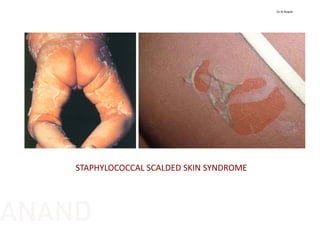 STAPHYLOCOCCAL SCALDED SKIN SYNDROME 
Dr N Anand
ANAND
 