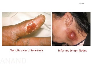Necrotic ulcer of tularemia Inflamed Lymph Nodes
Dr N Anand
ANAND
 