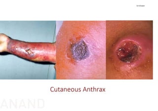 Cutaneous Anthrax
Dr N Anand
ANAND
 