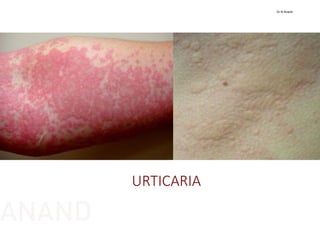 URTICARIA
Dr N Anand
ANAND
 