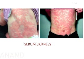 SERUM SICKNESS
Dr N Anand
ANAND
 