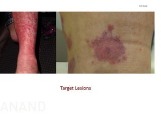Target Lesions
Dr N Anand
ANAND
 