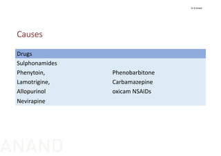 Causes
Drugs
Sulphonamides
Phenytoin,  Phenobarbitone
Lamotrigine,  Carbamazepine
Allopurinol oxicam NSAIDs
Nevirapine
Dr N Anand
ANAND
 
