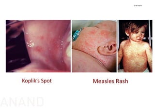 Measles RashKoplik’s Spot
Dr N Anand
ANAND
 