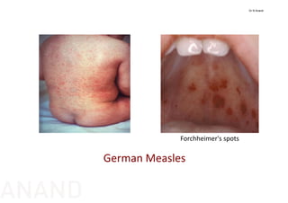 German Measles
Forchheimer's spots
Dr N Anand
ANAND
 
