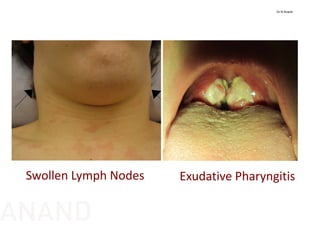Swollen Lymph Nodes Exudative Pharyngitis
Dr N Anand
ANAND
 