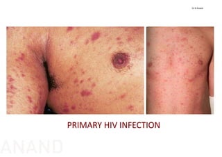 PRIMARY HIV INFECTION
Dr N Anand
ANAND
 