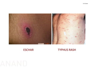 ESCHAR TYPHUS RASH
Dr N Anand
ANAND
 