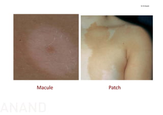Macule Patch
Dr N Anand
ANAND
 