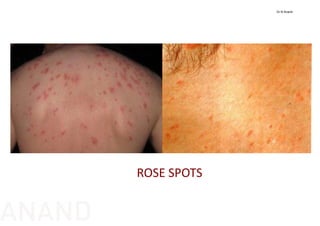 ROSE SPOTS
Dr N Anand
ANAND
 