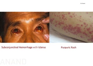Subconjunctival Hemorrhage with Icterus Purpuric Rash
Dr N Anand
ANAND
 