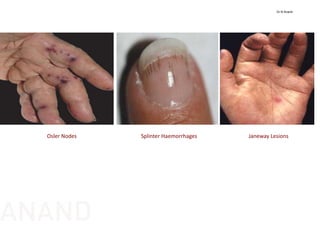 Janeway LesionsSplinter Haemorrhages Osler Nodes
Dr N Anand
ANAND
 